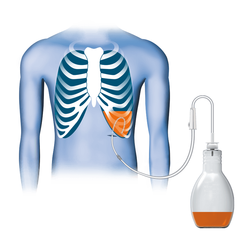Tüdő átmosás - Mikor alkalmazzák/Mikor van rá szükség?